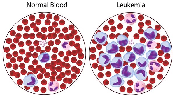 شديد Myeloid Leukemia