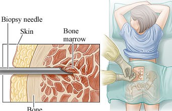 شديد Myeloid Leukemia