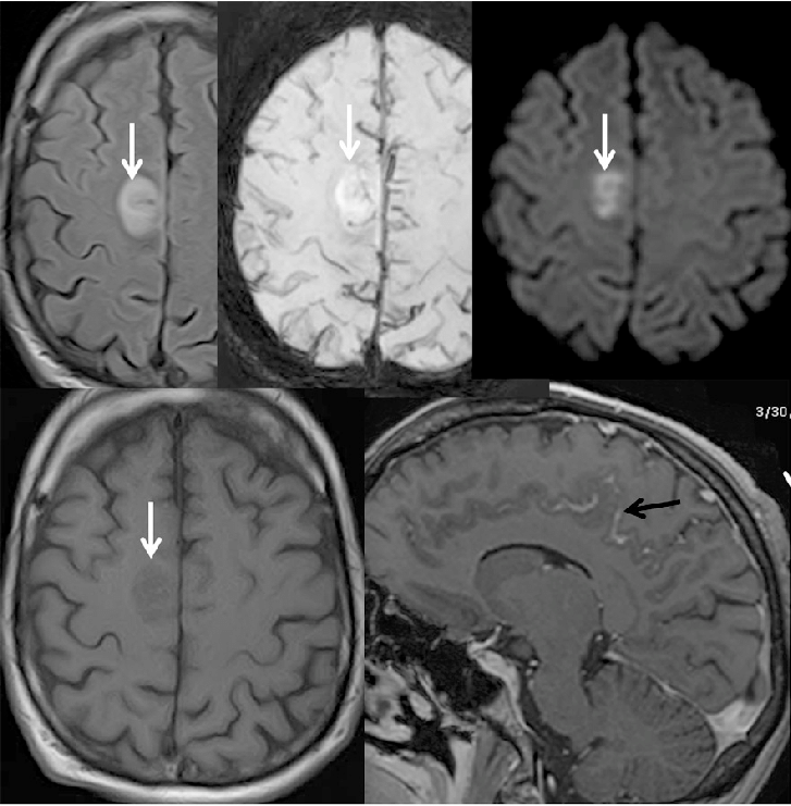 તીવ્ર માયલોઇડ લ્યુકેમિયા