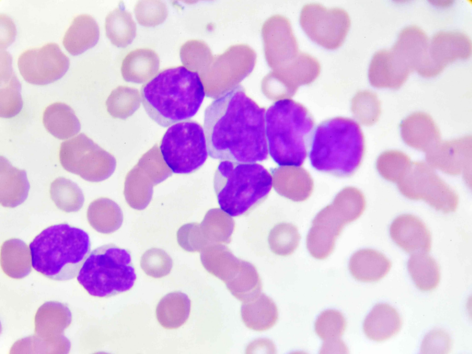 Acute myeloid leukaemia- Diagnosis