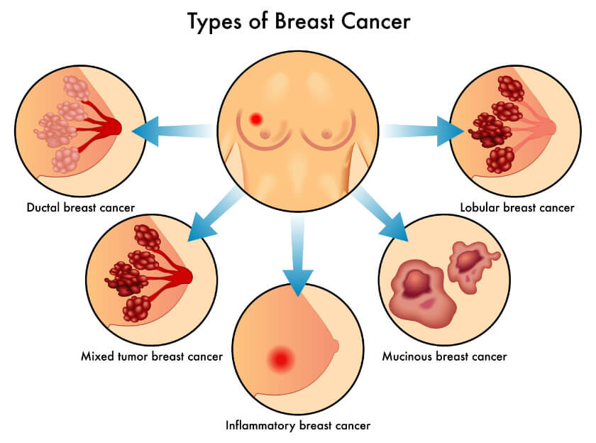 Breast Cancer and Types - ZenOnco.io