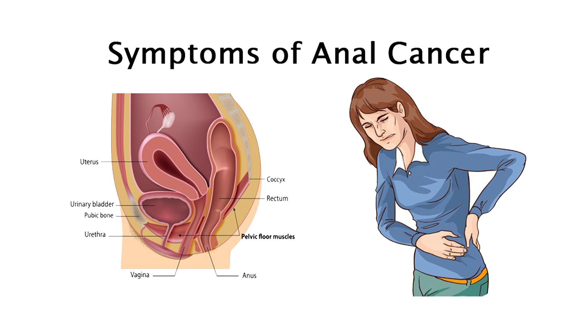 Symptoms of Anal Cancer photo