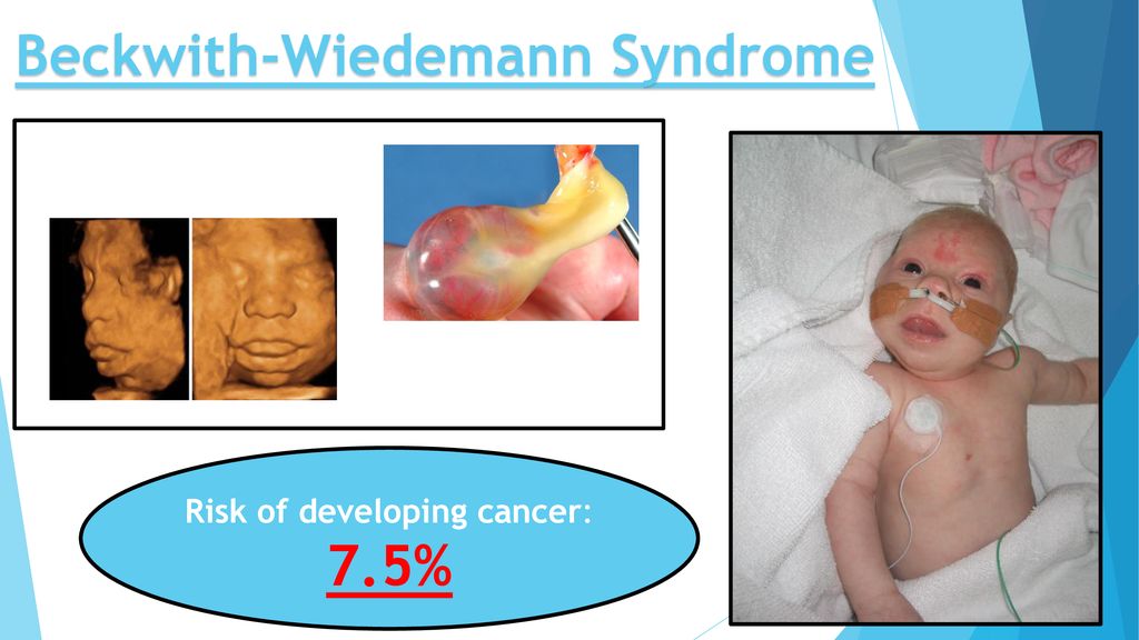 beckwith wiedemann syndrome genetics