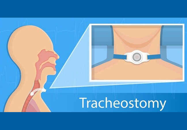 what is tracheostomy?