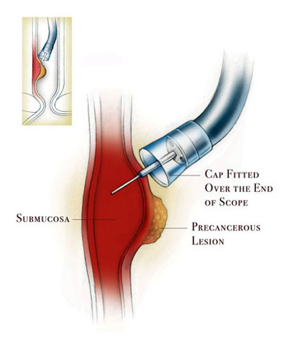 Endoscopic mucosal resection