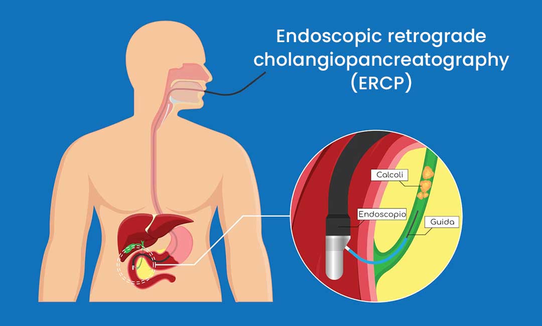 Endoscopic retrograde cholangiopancreatography (ERCP)