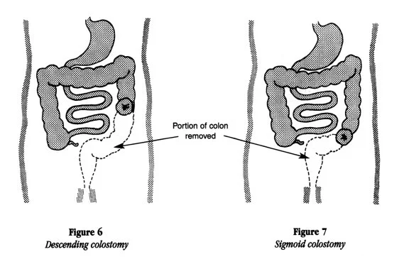Sigmoidal Colostomy