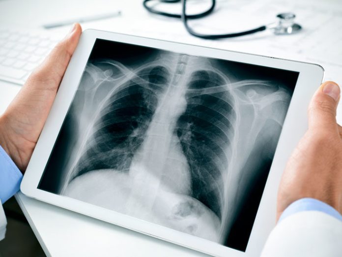 X-rays and Other Radiographic Tests for Cancer