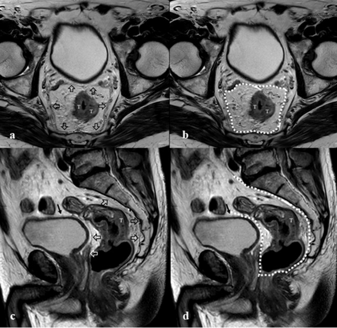 MRI for Cancer