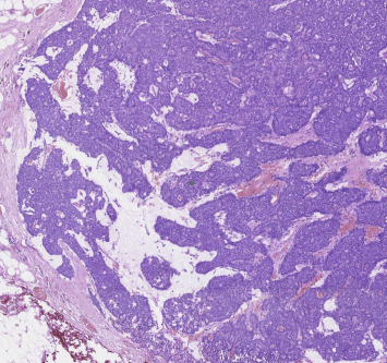 Breast Pathology