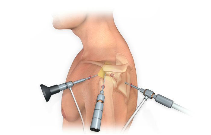 Arthroscopy