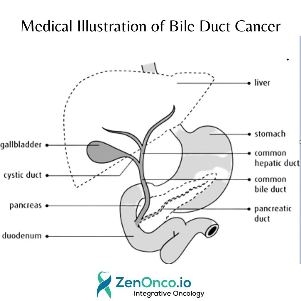 Medical Illustrations of Bile Duct Cancer