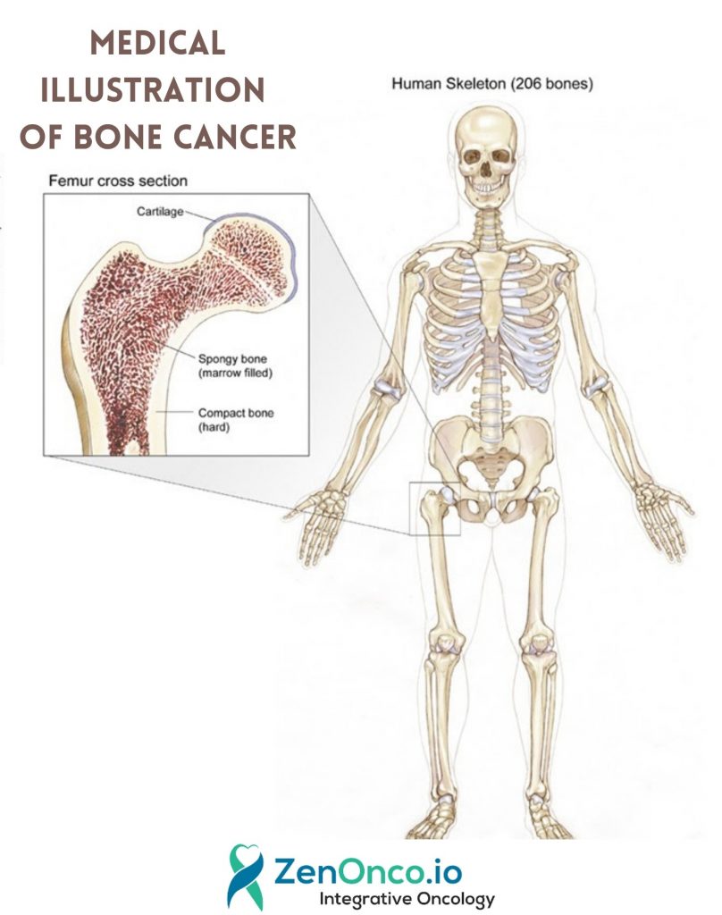 Medical Illustration of Bone cancer