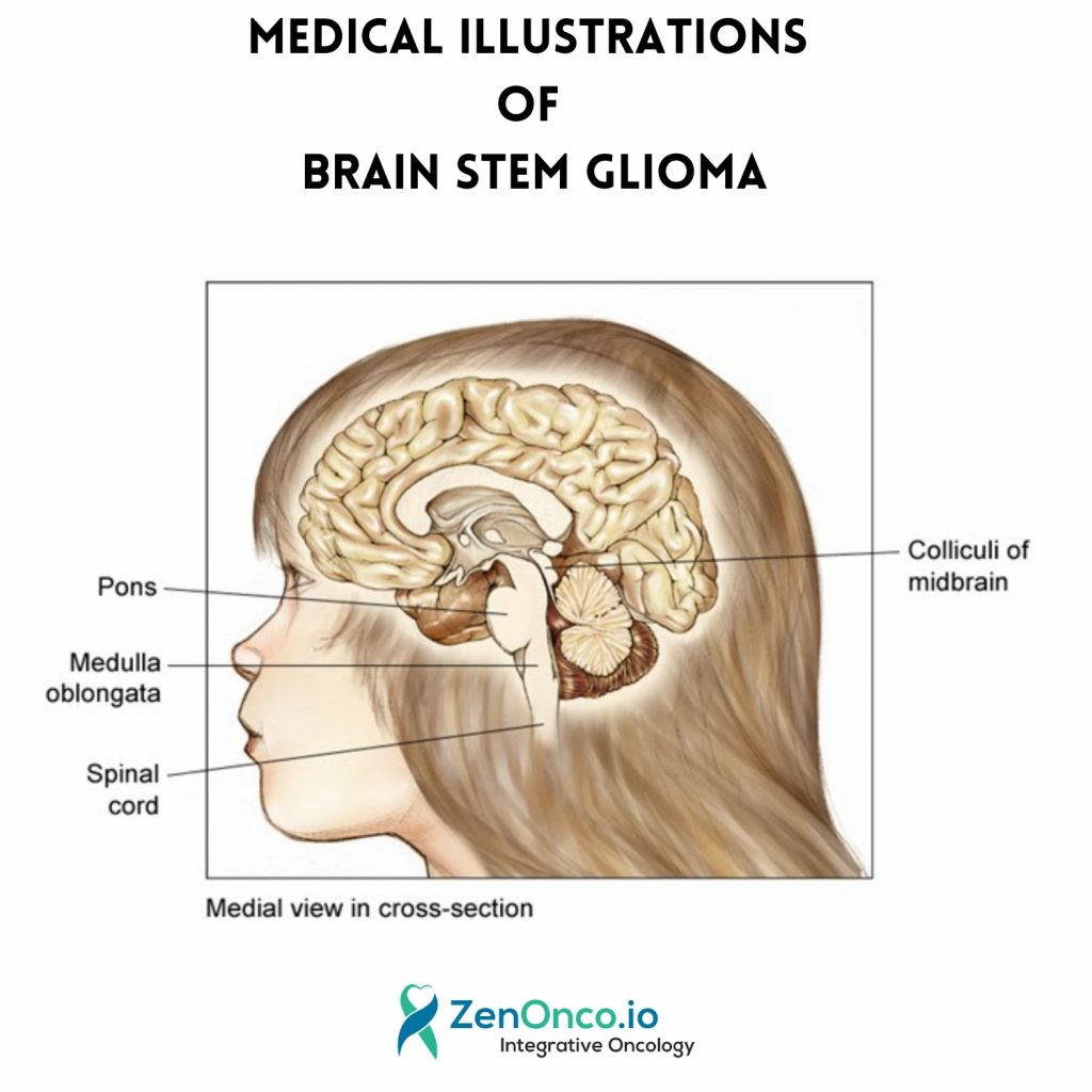 Medical Illustrations for Brain stem Glioma