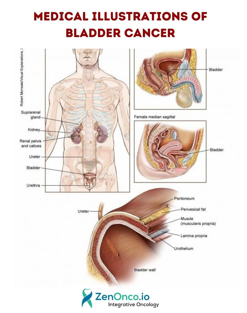 Medical Illustrations of Bladder Cancer