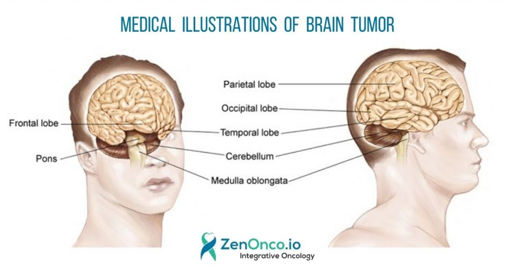 Medical Illustrations of Brain Tumor