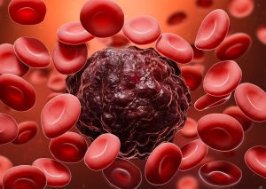 stages of blood cancer
