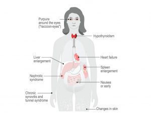 Risk Factors of Amyloidosis