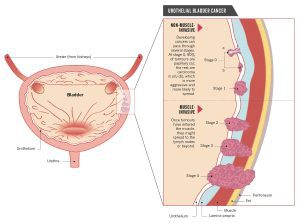 bladder cancer