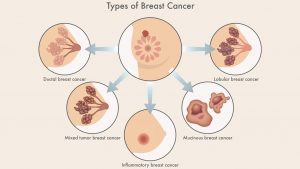 Inflammatory Breast cancer