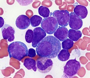 acute lymphocytic leukemia