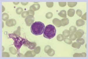 B-Cell Prolymphocytic Leukemia And Hairy Cell Leukemia