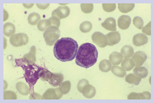 B-cell Prolymphocytic Leukemia ۽ Hairy Cell Leukemia