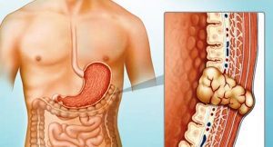 gastrointestinal stromal tumors