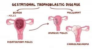 gestational trophoblastic disease