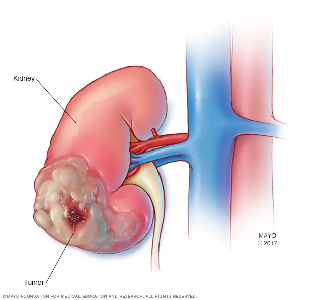 cancer kidney