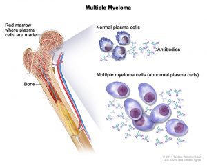 Multiple Myeloma