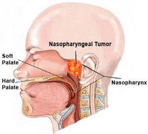 nasopharyngeal cancer