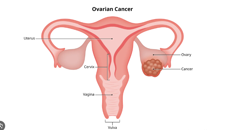 Ovarian Cancer Follow-up Care