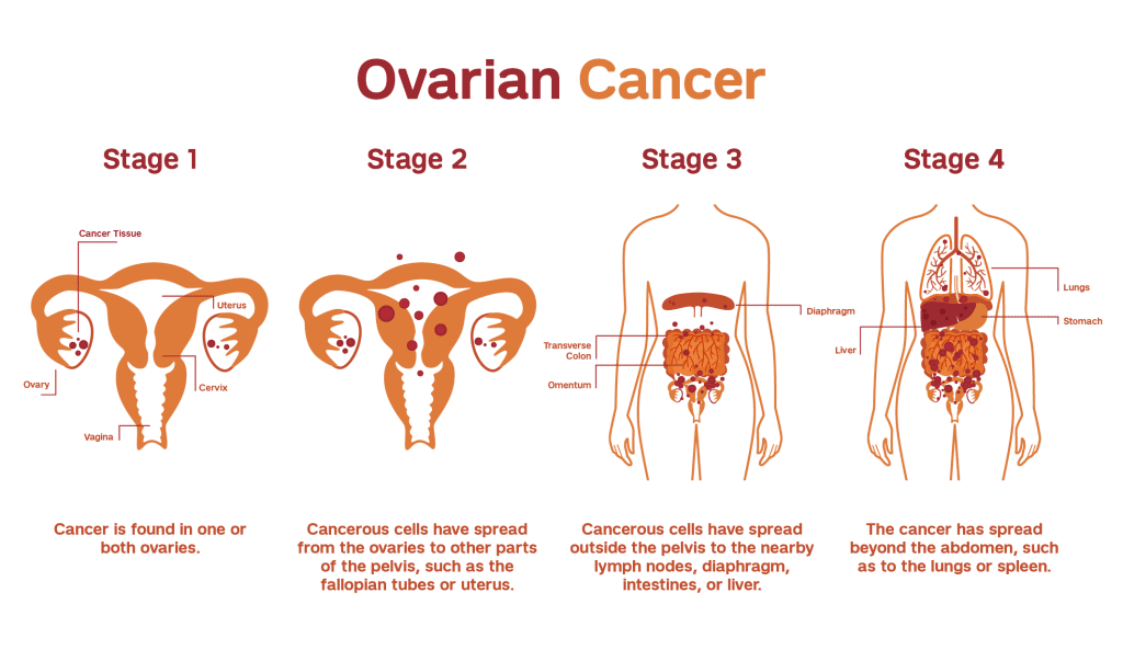 ovarian-cancer-stages-zenonco-io