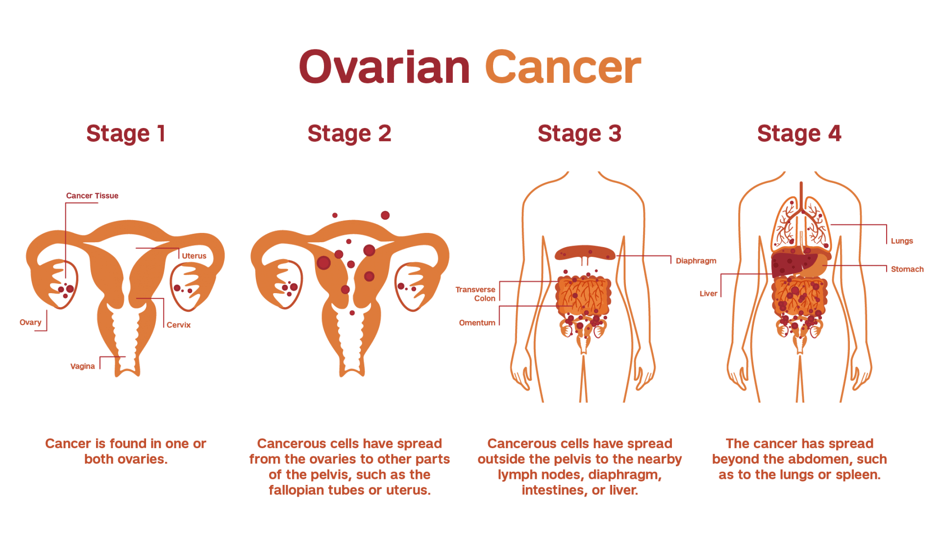 ovarian cancer stages