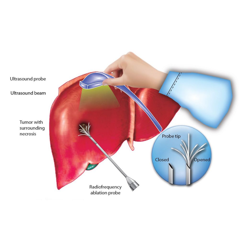 Radiofrequency Ablation 